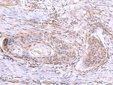 AKAP17A / 721P Antibody - Immunohistochemistry of paraffin-embedded Human esophagus cancer tissue  using AKAP17A Polyclonal Antibody at dilution of 1:80(×200)