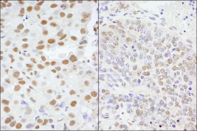 AKAP8 / AKAP95 Antibody - Detection of Human and Mouse AKAP8/AKAP95 by Immunohistochemistry. Sample: FFPE section of human breast carcinoma (left) and mouse teratoma (right). Antibody: Affinity purified rabbit anti-AKAP8/AKAP95 used at a dilution of 1:1000 (0.2 ug/ml) and 1:200 (1 ug/ml).