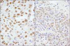 AKAP8 / AKAP95 Antibody - Detection of Human and Mouse AKAP8/AKAP95 by Immunohistochemistry. Sample: FFPE section of human breast carcinoma (left) and mouse teratoma (right). Antibody: Affinity purified rabbit anti-AKAP8/AKAP95 used at a dilution of 1:1000 (0.2 ug/ml) and 1:200 (1 ug/ml).