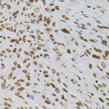 AKAP8 / AKAP95 Antibody - Immunohistochemistry of paraffin-embedded human lung cancer tissue.