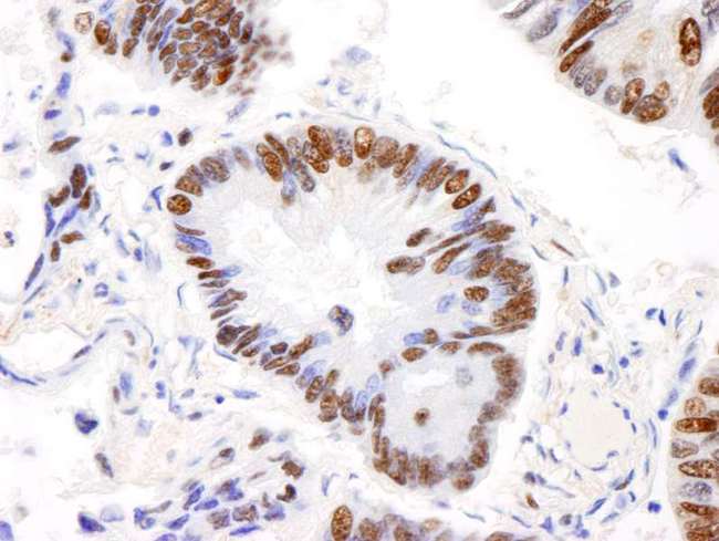 AKAP8L Antibody - Detection of Human AKAP8L/HA95 by Immunohistochemistry. Sample: FFPE section of human lung carcinoma. Antibody: Affinity purified rabbit anti-AKAP8L/HA95 used at a dilution of 1:200 (1 ug/ml).
