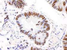 AKAP8L Antibody - Detection of Human AKAP8L/HA95 by Immunohistochemistry. Sample: FFPE section of human lung carcinoma. Antibody: Affinity purified rabbit anti-AKAP8L/HA95 used at a dilution of 1:200 (1 ug/ml).
