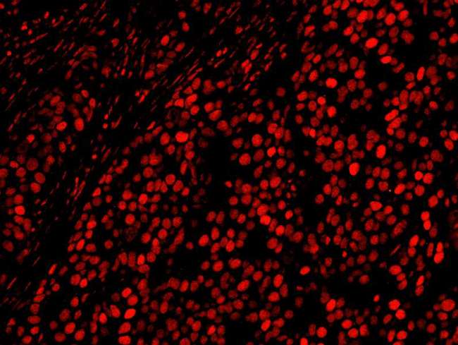 AKAP8L Antibody - Detection of Human AKAP8L/HA95 by Immunofluorescence. Sample: FFPE section of human breast carcinoma. Antibody: Affinity purified rabbit anti-AKAP8L/HA95 used at a dilution of 1:100. Detection: Red-fluorescent goat anti-rabbit IgG highly cross-adsorbed IHC Antibody Hilyte Plus 555 (A120-501E) used at a dilution of 1:100.