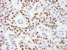 AKAP8L Antibody - Detection of Human AKAP8L/HA95 by Immunohistochemistry. Sample: FFPE section of human pancreatic islet cell tumor. Antibody: Affinity purified rabbit anti-AKAP8L/HA95 used at a dilution of 1:250.