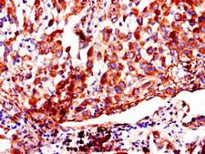 AKAP9 / YOTIAO Antibody - Immunohistochemistry of paraffin-embedded human lung cancer using AKAP9 Antibody at dilution of 1:100