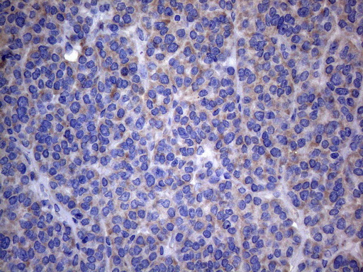 AKIP1 / BCA3 Antibody - Immunohistochemical staining of paraffin-embedded Carcinoma of Human thyroid tissue using anti-AKIP1 mouse monoclonal antibody. (Heat-induced epitope retrieval by 1mM EDTA in 10mM Tris buffer. (pH8.5) at 120°C for 3 min. (1:150)
