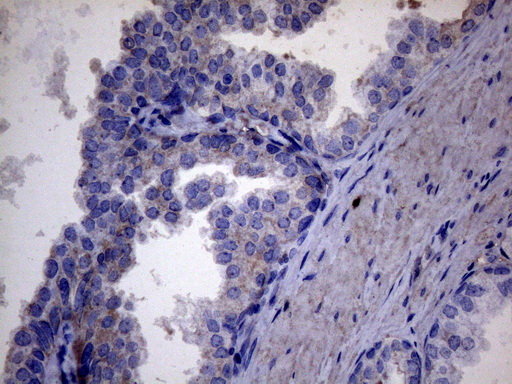 AKIP1 / BCA3 Antibody - Immunohistochemical staining of paraffin-embedded Carcinoma of Human prostate tissue using anti-AKIP1 mouse monoclonal antibody. (Heat-induced epitope retrieval by 1mM EDTA in 10mM Tris buffer. (pH8.5) at 120°C for 3 min. (1:150)