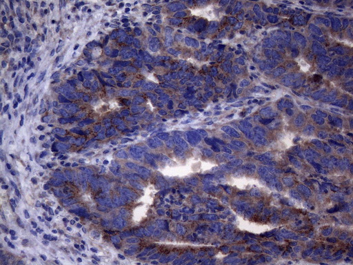 AKIP1 / BCA3 Antibody - Immunohistochemical staining of paraffin-embedded Adenocarcinoma of Human colon tissue using anti-AKIP1 mouse monoclonal antibody. (Heat-induced epitope retrieval by 1mM EDTA in 10mM Tris buffer. (pH8.5) at 120°C for 3 min. (1:150)
