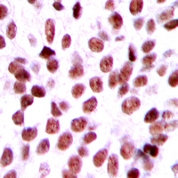 AKIP1 / BCA3 Antibody - Immunohistochemical analysis of BCA3 staining in human breast cancer formalin fixed paraffin embedded tissue section. The section was pre-treated using heat mediated antigen retrieval with sodium citrate buffer (pH 6.0). The section was then incubated with the antibody at room temperature and detected with HRP and DAB as chromogen. The section was then counterstained with hematoxylin and mounted with DPX.