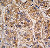 AKR1A1 Antibody - Formalin-fixed and paraffin-embedded human hepatocarcinoma tissue reacted with AKR1A1 antibody , which was peroxidase-conjugated to the secondary antibody, followed by DAB staining. This data demonstrates the use of this antibody for immunohistochemistry; clinical relevance has not been evaluated.