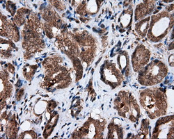 AKR1A1 Antibody - IHC of paraffin-embedded Carcinoma of prostate tissue using anti-AKR1A1 mouse monoclonal antibody. (Dilution 1:50).