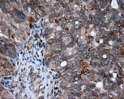 AKR1A1 Antibody - IHC of paraffin-embedded Adenocarcinoma of ovary tissue using anti-AKR1A1 mouse monoclonal antibody. (Dilution 1:50).