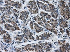 AKR1A1 Antibody - IHC of paraffin-embedded Carcinoma of liver tissue using anti-AKR1A1 mouse monoclonal antibody. (Dilution 1:50).
