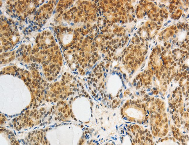 AKR1A1 Antibody - Immunohistochemistry of paraffin-embedded Human thyroid cancer using AKR1A1 Polyclonal Antibody at dilution of 1:25.
