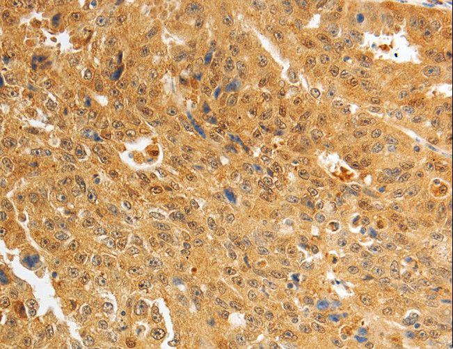 AKR1A1 Antibody - Immunohistochemistry of paraffin-embedded Human ovarian cancer using AKR1A1 Polyclonal Antibody at dilution of 1:25.