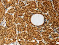 AKR1A1 Antibody - Immunohistochemistry of paraffin-embedded Human thyroid cancer using AKR1A1 Polyclonal Antibody at dilution of 1:30.