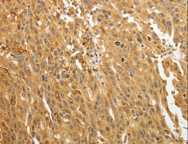 AKR1A1 Antibody - Immunohistochemistry of paraffin-embedded Human ovarian cancer using AKR1A1 Polyclonal Antibody at dilution of 1:30.