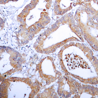 AKR1B1 / Aldose Reductase Antibody - Immunohistochemical analysis of Aldose Reductase staining in human colon cancer formalin fixed paraffin embedded tissue section. The section was pre-treated using heat mediated antigen retrieval with sodium citrate buffer (pH 6.0). The section was then incubated with the antibody at room temperature and detected using an HRP conjugated compact polymer system. DAB was used as the chromogen. The section was then counterstained with hematoxylin and mounted with DPX.