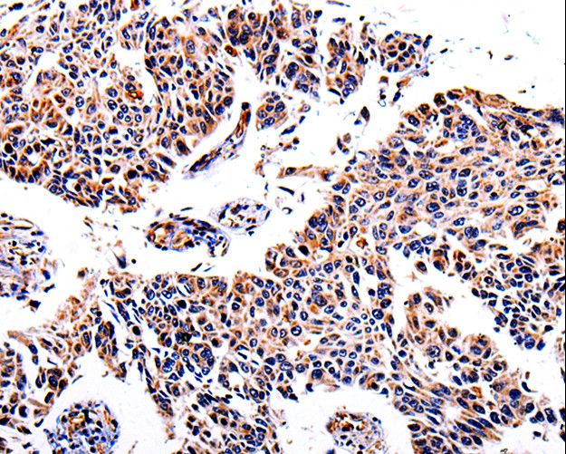 AKR1B1 / Aldose Reductase Antibody - Immunohistochemistry of paraffin-embedded Human lung cancer using AKR1B1 Polyclonal Antibody at dilution of 1:40.