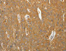 AKR1B1 / Aldose Reductase Antibody - Immunohistochemistry of paraffin-embedded Human ovarian cancer using AKR1B1 Polyclonal Antibody at dilution of 1:40.