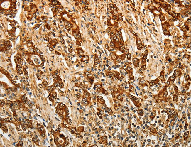 AKR1B1 / Aldose Reductase Antibody - Immunohistochemistry of paraffin-embedded Human gastric cancer using AKR1B1 Polyclonal Antibody at dilution of 1:40.