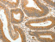 AKR1B1 / Aldose Reductase Antibody - Immunohistochemistry of paraffin-embedded Human colon cancer using AKR1B1 Polyclonal Antibody at dilution of 1:30.