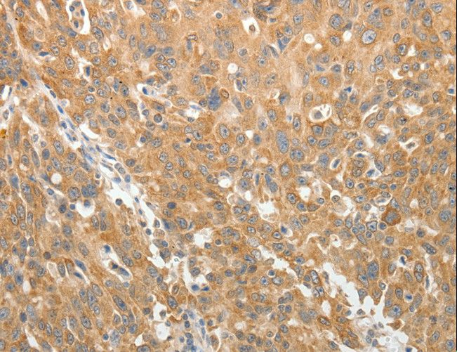 AKR1B1 / Aldose Reductase Antibody - Immunohistochemistry of paraffin-embedded Human ovarian cancer using AKR1B1 Polyclonal Antibody at dilution of 1:30.
