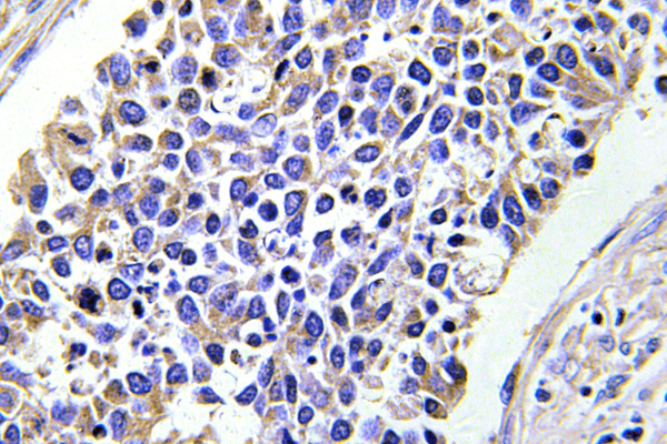 AKR1B1 / Aldose Reductase Antibody - IHC of Aldose Reductase (K275) pAb in paraffin-embedded human lung carcinoma tissue.
