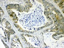 AKR1B10 Antibody - IHC testing of FFPE human intestinal cancer tissue with AKR1B10 antibody at 1ug/ml. Required HIER: steam section in pH6 citrate buffer for 20 min and allow to cool prior to testing.