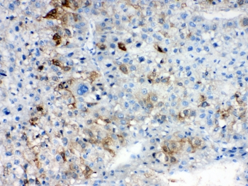 AKR1B10 Antibody - IHC testing of FFPE human liver cancer tissue with AKR1B10 antibody at 1ug/ml. Required HIER: steam section in pH6 citrate buffer for 20 min and allow to cool prior to testing.