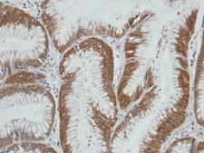 AKR1C4 / Chlordecone Reductase Antibody - IHC of paraffin-embedded gastric ca using AKR1C4 antibody at 1:100 dilution.
