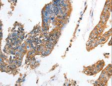 AKR1D1 Antibody - Immunohistochemistry of paraffin-embedded Human colon cancer using AKR1D1 Polyclonal Antibody at dilution of 1:35.