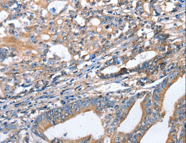 AKR1D1 Antibody - Immunohistochemistry of paraffin-embedded Human gastric cancer using AKR1D1 Polyclonal Antibody at dilution of 1:35.