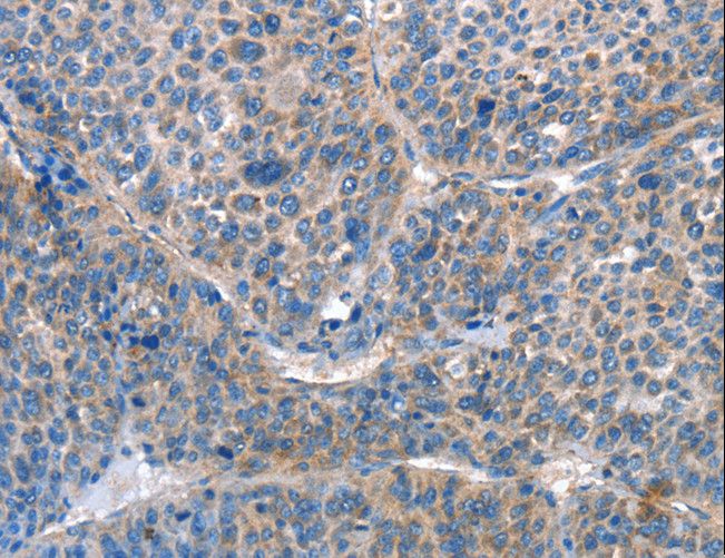 AKR1D1 Antibody - Immunohistochemistry of paraffin-embedded Human liver cancer using AKR1D1 Polyclonal Antibody at dilution of 1:25.