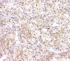 AKR1D1 Antibody - IHC staining of FFPE human liver cancer with AKR1D1 antibody at 1ug/ml. HIER: boil tissue sections in pH6, 10mM citrate buffer, for 10-20 min and allow to cool before testing.