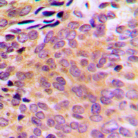 AKR1E2 Antibody - Immunohistochemical analysis of AKR1CL2 staining in human breast cancer formalin fixed paraffin embedded tissue section. The section was pre-treated using heat mediated antigen retrieval with sodium citrate buffer (pH 6.0). The section was then incubated with the antibody at room temperature and detected using an HRP conjugated compact polymer system. DAB was used as the chromogen. The section was then counterstained with hematoxylin and mounted with DPX.
