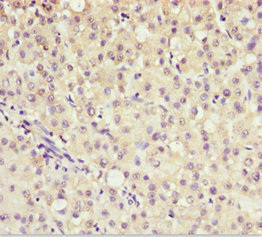 AKR7A2 / AFAR Antibody - Immunohistochemistry of paraffin-embedded human liver cancer at dilution 1:100
