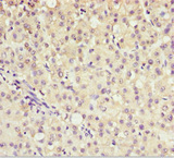 AKR7A2 / AFAR Antibody - Immunohistochemistry of paraffin-embedded human liver cancer at dilution 1:100
