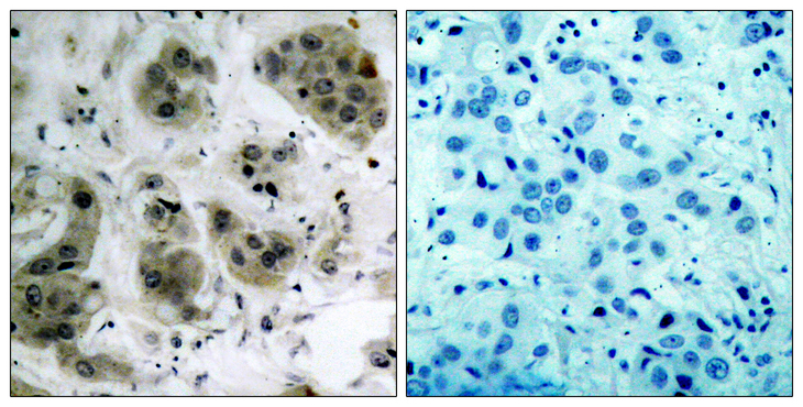 AKT1 + AKT2 + AKT3 Antibody - Immunohistochemistry analysis of paraffin-embedded human breast carcinoma tissue, using Akt Antibody. The picture on the right is blocked with the synthesized peptide.