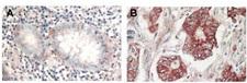 AKT1 + AKT2 + AKT3 Antibody - Immunohistochemistry of rabbit Anti-AKT antibody. Tissue: (A) normal colon tissue, (B) colon tumor tissue. Fixation: formalin fixed paraffin embedded. Antigen retrieval: not required. Primary antibody: AKT antibody at 1:1,000 dilution for 1 h at RT. Secondary antibody: Peroxidase rabbit secondary antibody at 1:10,000 for 45 min at RT. Localization: AKT is nuclear. Staining: AKT as precipitated red signal with hematoxylin purple nuclear counterstain.
