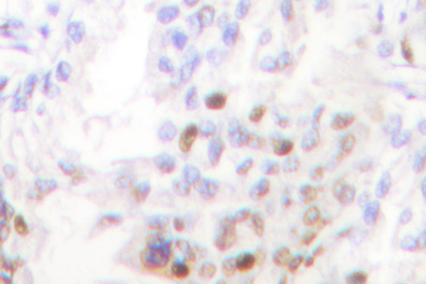 AKT1 + AKT2 + AKT3 Antibody - IHC of Akt (A444) pAb in paraffin-embedded human lung carcinoma tissue.