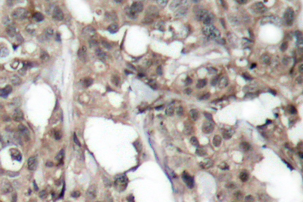 AKT1 + AKT2 + AKT3 Antibody - IHC of Akt (D302) pAb in paraffin-embedded human breast carcinoma tissue.