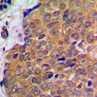AKT1 + AKT2 + AKT3 Antibody - Immunohistochemical analysis of AKT staining in human breast cancer formalin fixed paraffin embedded tissue section. The section was pre-treated using heat mediated antigen retrieval with sodium citrate buffer (pH 6.0). The section was then incubated with the antibody at room temperature and detected using an HRP conjugated compact polymer system. DAB was used as the chromogen. The section was then counterstained with hematoxylin and mounted with DPX.
