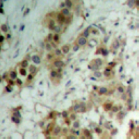 AKT1 + AKT2 + AKT3 Antibody - Immunohistochemical analysis of AKT (pT450) staining in human breast cancer formalin fixed paraffin embedded tissue section. The section was pre-treated using heat mediated antigen retrieval with sodium citrate buffer (pH 6.0). The section was then incubated with the antibody at room temperature and detected using an HRP conjugated compact polymer system. DAB was used as the chromogen. The section was then counterstained with hematoxylin and mounted with DPX.