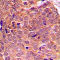 AKT1 + AKT2 + AKT3 Antibody - Immunohistochemical analysis of AKT staining in human breast cancer formalin fixed paraffin embedded tissue section. The section was pre-treated using heat mediated antigen retrieval with sodium citrate buffer (pH 6.0). The section was then incubated with the antibody at room temperature and detected using an HRP conjugated compact polymer system. DAB was used as the chromogen. The section was then counterstained with hematoxylin and mounted with DPX.