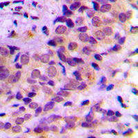 AKT1 + AKT2 + AKT3 Antibody - Immunohistochemical analysis of AKT staining in human prostate cancer formalin fixed paraffin embedded tissue section. The section was pre-treated using heat mediated antigen retrieval with sodium citrate buffer (pH 6.0). The section was then incubated with the antibody at room temperature and detected using an HRP conjugated compact polymer system. DAB was used as the chromogen. The section was then counterstained with hematoxylin and mounted with DPX. w