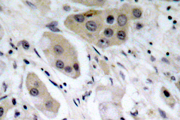 AKT1 + AKT2 + AKT3 Antibody - IHC of p-Akt (S473) pAb in paraffin-embedded human breast carcinoma tissue.