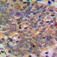 AKT1 + AKT2 + AKT3 Antibody - Immunohistochemical analysis of AKT (pS473) staining in human breast cancer formalin fixed paraffin embedded tissue section. The section was pre-treated using heat mediated antigen retrieval with sodium citrate buffer (pH 6.0). The section was then incubated with the antibody at room temperature and detected using an HRP conjugated compact polymer system. DAB was used as the chromogen. The section was then counterstained with hematoxylin and mounted with DPX.