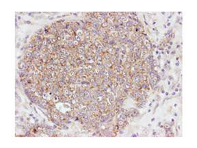 AKT1 + AKT2 + AKT3 Antibody - Immunohistochemistry of rabbit Anti-Akt pS473 antibody. Tissue: human breast carcinoma. Fixation: formalin fixed paraffin embedded. Antigen retrieval: not required. Primary antibody: Akt pS473 antibody at 100 dilution for 1 h at RT. Secondary antibody: Dako's Techmate streptavidin-biotin reagents at 1:10,000 for 45 min at RT. Localization: Akt pS473 is nuclear and occasionally cytoplasmic.