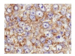 AKT1 + AKT2 + AKT3 Antibody - Immunohistochemistry at higher magnification of rabbit Anti-Akt pS473 antibody. Tissue: human breast carcinoma. Fixation: formalin fixed paraffin embedded. Antigen retrieval: not required. Primary antibody: Akt pS473 antibody at 100 dilution for 1 h at RT. Secondary antibody: Dako's Techmate streptavidin-biotin reagents at 1:10,000 for 45 min at RT. Localization: Akt pS473 is nuclear and occasionally cytoplasmic.